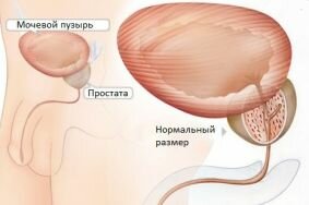 Терапия инфекционного простатита