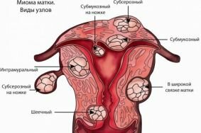 Особенности развития миомы во время менопаузы