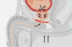Какими осложнениями чревато воспаление простаты
