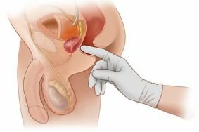 С какой целью назначается проведение массажа предстательной железы