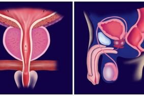 Методы диагностики и преодоления хронического простатита
