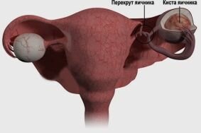 Причины образования кисты в яичнике в период менопаузы