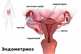 Опасность развития эндометриоза в период менопаузы