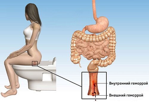 геморрой у женщин