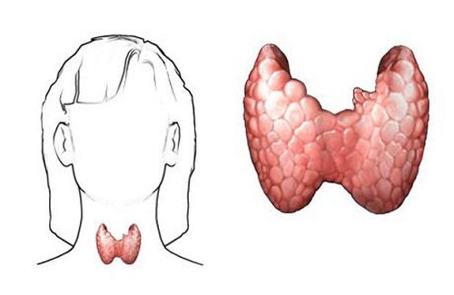 Гипотиреоз щитовидной железы